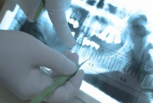 Neodent implant costs