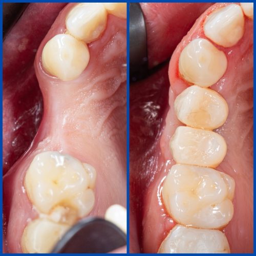 Dental Augmentation