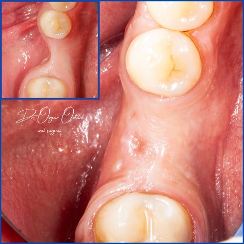 Dental Augmentation 2