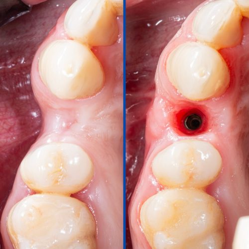 Dental Augmentation 3